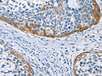 The image on the left is immunohistochemistry of paraffin-embedded Human cervical cancer tissue using CSB-PA210441(C3AR1 Antibody) at dilution 1/25, on the right is treated with fusion protein. (Original magnification: x200)