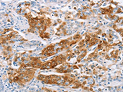 The image on the left is immunohistochemistry of paraffin-embedded Human prostate cancer tissue using CSB-PA210441(C3AR1 Antibody) at dilution 1/25, on the right is treated with fusion protein. (Original magnification: x200) The image on the left is immunohistochemistry of paraffin-embedded Human prostate cancer tissue using CSB-PA210441(C3AR1 Antibody) at dilution 1/25, on the right is treated with fusion protein. (Original magnification: x200)