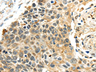 The image on the left is immunohistochemistry of paraffin-embedded Human esophagus cancer tissue using CSB-PA215840(PROX1 Antibody) at dilution 1/40, on the right is treated with synthetic peptide. (Original magnification: x200)