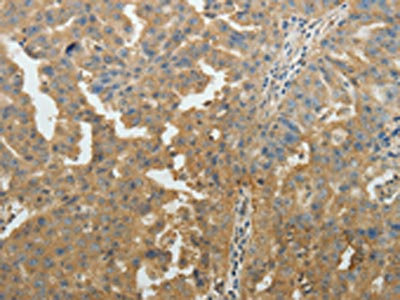 The image on the left is immunohistochemistry of paraffin-embedded Human ovarian cancer tissue using CSB-PA216465(SYT6 Antibody) at dilution 1/40, on the right is treated with fusion protein. (Original magnification: x200)