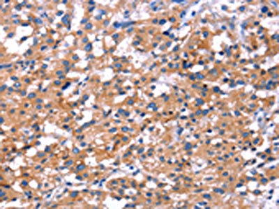 The image on the left is immunohistochemistry of paraffin-embedded Human thyroid cancer tissue using CSB-PA230288(IRS1 Antibody) at dilution 1/30, on the right is treated with fusion protein. (Original magnification: x200) The image on the left is immunohistochemistry of paraffin-embedded Human thyroid cancer tissue using CSB-PA230288(IRS1 Antibody) at dilution 1/30, on the right is treated with fusion protein. (Original magnification: x200)
