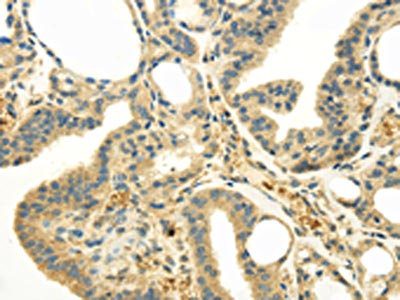 The image on the left is immunohistochemistry of paraffin-embedded Human thyroid cancer tissue using CSB-PA230502(UGT1A6 Antibody) at dilution 1/20, on the right is treated with synthetic peptide. (Original magnification: x200)