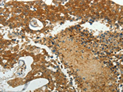 The image on the left is immunohistochemistry of paraffin-embedded Human breast cancer tissue using CSB-PA232265(MCM4 Antibody) at dilution 1/40, on the right is treated with synthetic peptide. (Original magnification: x200)