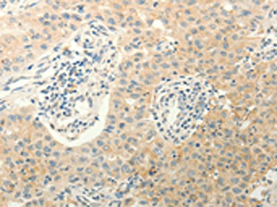 The image on the left is immunohistochemistry of paraffin-embedded Human lung cancer tissue using CSB-PA233398(ERG Antibody) at dilution 1/40, on the right is treated with fusion protein. (Original magnification: x200)