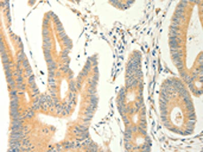 The image on the left is immunohistochemistry of paraffin-embedded Human colon cancer tissue using CSB-PA233398(ERG Antibody) at dilution 1/40, on the right is treated with fusion protein. (Original magnification: x200)
