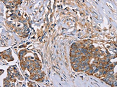 The image on the left is immunohistochemistry of paraffin-embedded Human cervical cancer tissue using CSB-PA234848(FAIM2 Antibody) at dilution 1/30, on the right is treated with fusion protein. (Original magnification: x200)