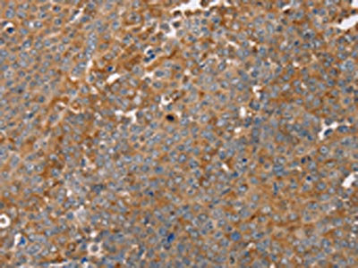 The image on the left is immunohistochemistry of paraffin-embedded Human ovarian cancer tissue using CSB-PA234848(FAIM2 Antibody) at dilution 1/30, on the right is treated with fusion protein. (Original magnification: x200)