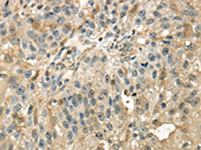 The image on the left is immunohistochemistry of paraffin-embedded Human breast cancer tissue using CSB-PA239298(RAB17 Antibody) at dilution 1/40, on the right is treated with synthetic peptide. (Original magnification: x200)