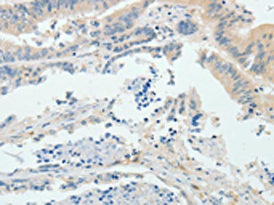 The image on the left is immunohistochemistry of paraffin-embedded Human colon cancer tissue using CSB-PA241902(RPS6KB1 Antibody) at dilution 1/25, on the right is treated with fusion protein. (Original magnification: x200)