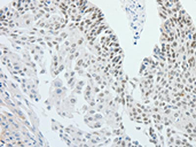 The image on the left is immunohistochemistry of paraffin-embedded Human cervical cancer tissue using CSB-PA241902(RPS6KB1 Antibody) at dilution 1/25, on the right is treated with fusion protein. (Original magnification: x200) The image on the left is immunohistochemistry of paraffin-embedded Human cervical cancer tissue using CSB-PA241902(RPS6KB1 Antibody) at dilution 1/25, on the right is treated with fusion protein. (Original magnification: x200)
