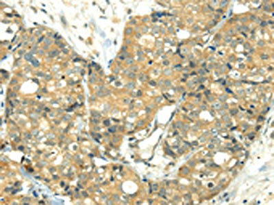 The image on the left is immunohistochemistry of paraffin-embedded Human breast cancer tissue using CSB-PA242603(TRIM10 Antibody) at dilution 1/35, on the right is treated with fusion protein. (Original magnification: x200)