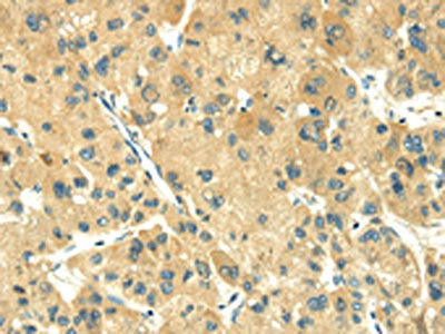 The image on the left is immunohistochemistry of paraffin-embedded Human liver cancer tissue using CSB-PA242603(TRIM10 Antibody) at dilution 1/35, on the right is treated with fusion protein. (Original magnification: x200)