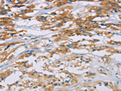 The image on the left is immunohistochemistry of paraffin-embedded Human thyroid cancer tissue using CSB-PA243594(CD33 Antibody) at dilution 1/40, on the right is treated with fusion protein. (Original magnification: x200)