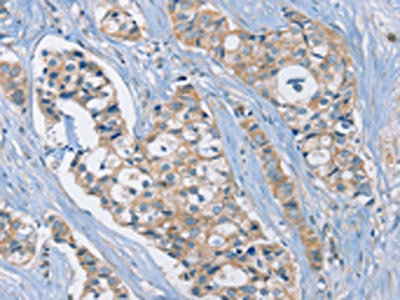 The image on the left is immunohistochemistry of paraffin-embedded Human breast cancer tissue using CSB-PA247431(RAD51 Antibody) at dilution 1/25, on the right is treated with synthetic peptide. (Original magnification: x200)