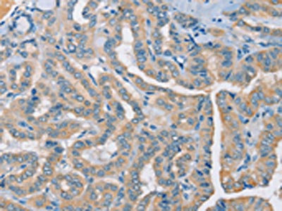 The image on the left is immunohistochemistry of paraffin-embedded Human thyroid cancer tissue using CSB-PA247431(RAD51 Antibody) at dilution 1/25, on the right is treated with synthetic peptide. (Original magnification: x200) The image on the left is immunohistochemistry of paraffin-embedded Human thyroid cancer tissue using CSB-PA247431(RAD51 Antibody) at dilution 1/25, on the right is treated with synthetic peptide. (Original magnification: x200)
