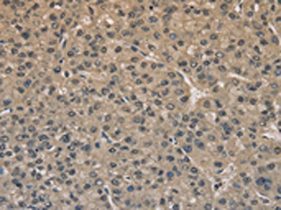 The image on the left is immunohistochemistry of paraffin-embedded Human liver cancer tissue using CSB-PA248125(DRG1 Antibody) at dilution 1/20, on the right is treated with fusion protein. (Original magnification: x200)