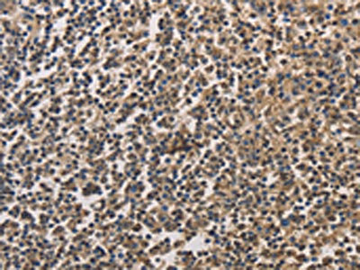 The image on the left is immunohistochemistry of paraffin-embedded Human tonsil tissue using CSB-PA248125(DRG1 Antibody) at dilution 1/20, on the right is treated with fusion protein. (Original magnification: x200)