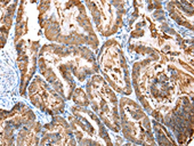 The image on the left is immunohistochemistry of paraffin-embedded Human esophagus cancer tissue using CSB-PA250029(CXCR4 Antibody) at dilution 1/20, on the right is treated with synthetic peptide. (Original magnification: x200) The image on the left is immunohistochemistry of paraffin-embedded Human esophagus cancer tissue using CSB-PA250029(CXCR4 Antibody) at dilution 1/20, on the right is treated with synthetic peptide. (Original magnification: x200)