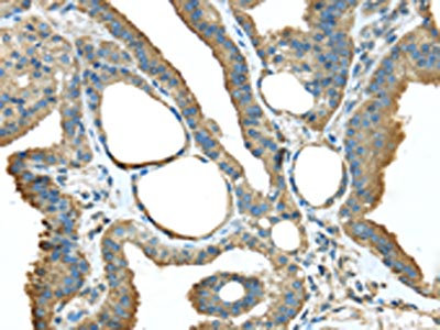 The image on the left is immunohistochemistry of paraffin-embedded Human thyroid cancer tissue using CSB-PA250986(TMED1 Antibody) at dilution 1/35, on the right is treated with fusion protein. (Original magnification: x200)