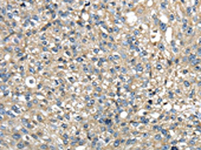 The image on the left is immunohistochemistry of paraffin-embedded Human breast cancer tissue using CSB-PA250986(TMED1 Antibody) at dilution 1/35, on the right is treated with fusion protein. (Original magnification: x200)