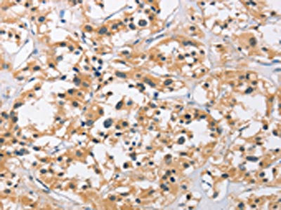 The image on the left is immunohistochemistry of paraffin-embedded Human thyroid cancer tissue using CSB-PA251074(C3AR1 Antibody) at dilution 1/50, on the right is treated with fusion protein. (Original magnification: x200)