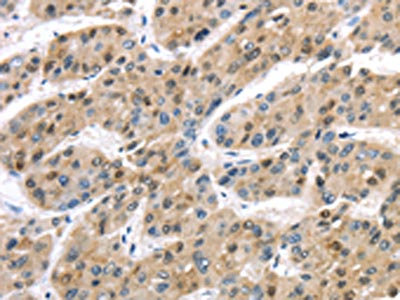 The image on the left is immunohistochemistry of paraffin-embedded Human liver cancer tissue using CSB-PA251266(TAB1 Antibody) at dilution 1/30, on the right is treated with synthetic peptide. (Original magnification: x200)