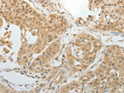 The image on the left is immunohistochemistry of paraffin-embedded Human lung cancer tissue using CSB-PA256025(MAP4 Antibody) at dilution 1/10, on the right is treated with fusion protein. (Original magnification: x200)