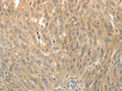 The image on the left is immunohistochemistry of paraffin-embedded Human ovarian cancer tissue using CSB-PA256025(MAP4 Antibody) at dilution 1/10, on the right is treated with fusion protein. (Original magnification: x200) The image on the left is immunohistochemistry of paraffin-embedded Human ovarian cancer tissue using CSB-PA256025(MAP4 Antibody) at dilution 1/10, on the right is treated with fusion protein. (Original magnification: x200)