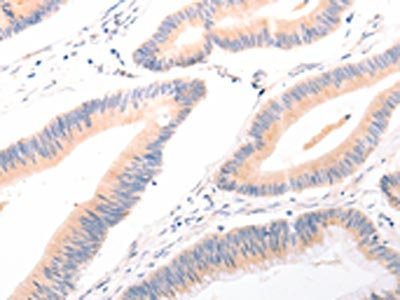 The image on the left is immunohistochemistry of paraffin-embedded Human colon cancer tissue using CSB-PA260955(ACR Antibody) at dilution 1/20, on the right is treated with synthetic peptide. (Original magnification: x200)