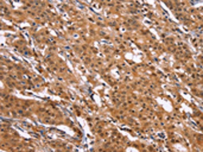 The image on the left is immunohistochemistry of paraffin-embedded Human gastric cancer tissue using CSB-PA262509(MAP3K2 Antibody) at dilution 1/20, on the right is treated with synthetic peptide. (Original magnification: x200)