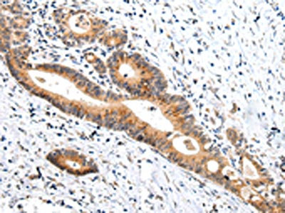 The image on the left is immunohistochemistry of paraffin-embedded Human colorectal cancer tissue using CSB-PA263065(ZNF281 Antibody) at dilution 1/35, on the right is treated with synthetic peptide. (Original magnification: x200)