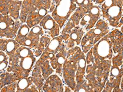 The image on the left is immunohistochemistry of paraffin-embedded Human thyroid cancer tissue using CSB-PA263065(ZNF281 Antibody) at dilution 1/35, on the right is treated with synthetic peptide. (Original magnification: x200)