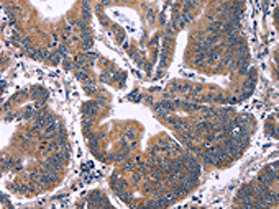 The image on the left is immunohistochemistry of paraffin-embedded Human colon cancer tissue using CSB-PA266125(ING2 Antibody) at dilution 1/60, on the right is treated with fusion protein. (Original magnification: x200)