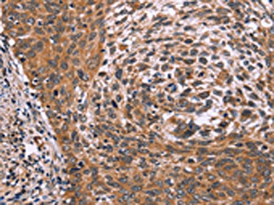 The image on the left is immunohistochemistry of paraffin-embedded Human cervical cancer tissue using CSB-PA266125(ING2 Antibody) at dilution 1/60, on the right is treated with fusion protein. (Original magnification: x200)