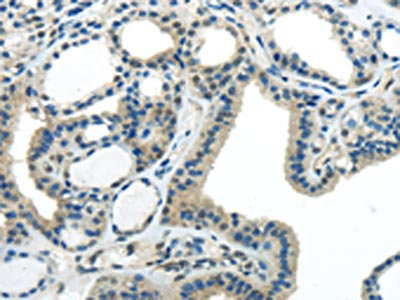 The image on the left is immunohistochemistry of paraffin-embedded Human thyroid cancer tissue using CSB-PA270025(IL-20 Antibody) at dilution 1/35, on the right is treated with synthetic peptide. (Original magnification: x200)
