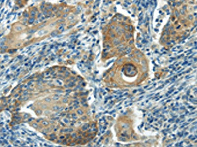 The image on the left is immunohistochemistry of paraffin-embedded Human cervical cancer tissue using CSB-PA270025(IL-20 Antibody) at dilution 1/35, on the right is treated with synthetic peptide. (Original magnification: x200) The image on the left is immunohistochemistry of paraffin-embedded Human cervical cancer tissue using CSB-PA270025(IL-20 Antibody) at dilution 1/35, on the right is treated with synthetic peptide. (Original magnification: x200)