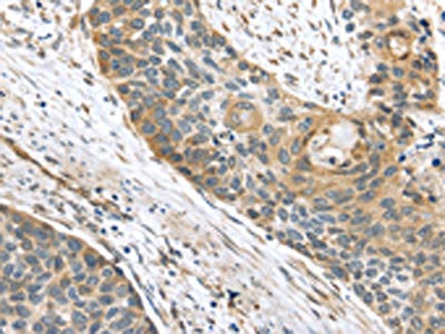 The image on the left is immunohistochemistry of paraffin-embedded Human esophagus cancer tissue using CSB-PA277474(TMED2 Antibody) at dilution 1/25, on the right is treated with fusion protein. (Original magnification: x200)
