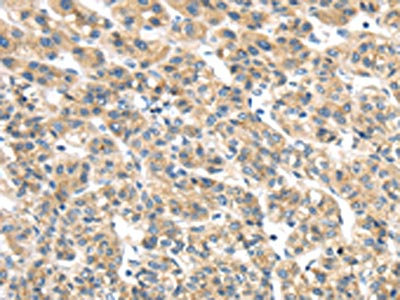 The image on the left is immunohistochemistry of paraffin-embedded Human liver cancer tissue using CSB-PA277474(TMED2 Antibody) at dilution 1/25, on the right is treated with fusion protein. (Original magnification: x200)