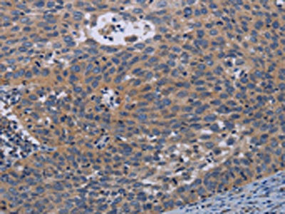 The image on the left is immunohistochemistry of paraffin-embedded Human cervical cancer tissue using CSB-PA277916(PAPPA Antibody) at dilution 1/50, on the right is treated with synthetic peptide. (Original magnification: x200) The image on the left is immunohistochemistry of paraffin-embedded Human cervical cancer tissue using CSB-PA277916(PAPPA Antibody) at dilution 1/50, on the right is treated with synthetic peptide. (Original magnification: x200)