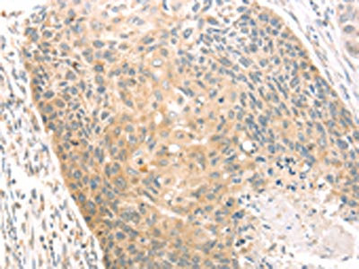 The image on the left is immunohistochemistry of paraffin-embedded Human esophagus cancer tissue using CSB-PA277938(SCAP Antibody) at dilution 1/20, on the right is treated with fusion protein. (Original magnification: x200)
