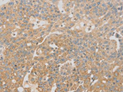 The image on the left is immunohistochemistry of paraffin-embedded Human breast cancer tissue using CSB-PA277938(SCAP Antibody) at dilution 1/20, on the right is treated with fusion protein. (Original magnification: x200) The image on the left is immunohistochemistry of paraffin-embedded Human breast cancer tissue using CSB-PA277938(SCAP Antibody) at dilution 1/20, on the right is treated with fusion protein. (Original magnification: x200)