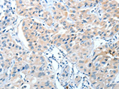 The image on the left is immunohistochemistry of paraffin-embedded Human lung cancer tissue using CSB-PA279247(IL22RA1 Antibody) at dilution 1/15, on the right is treated with fusion protein. (Original magnification: x200)