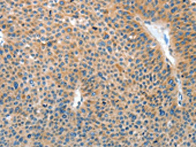 The image on the left is immunohistochemistry of paraffin-embedded Human liver cancer tissue using CSB-PA279247(IL22RA1 Antibody) at dilution 1/15, on the right is treated with fusion protein. (Original magnification: x200)