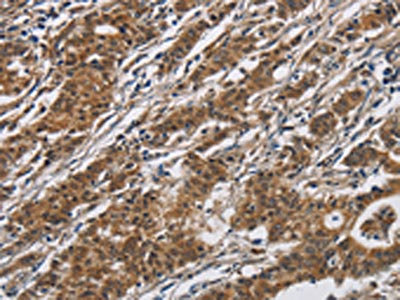 The image on the left is immunohistochemistry of paraffin-embedded Human gastric cancer tissue using CSB-PA283024(DHRS3 Antibody) at dilution 1/30, on the right is treated with fusion protein. (Original magnification: x200)