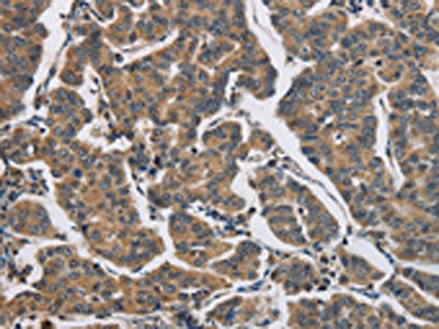 The image on the left is immunohistochemistry of paraffin-embedded Human breast cancer tissue using CSB-PA283024(DHRS3 Antibody) at dilution 1/30, on the right is treated with fusion protein. (Original magnification: x200) The image on the left is immunohistochemistry of paraffin-embedded Human breast cancer tissue using CSB-PA283024(DHRS3 Antibody) at dilution 1/30, on the right is treated with fusion protein. (Original magnification: x200)