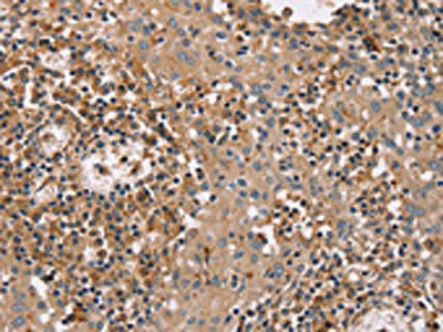 The image on the left is immunohistochemistry of paraffin-embedded Human tonsil tissue using CSB-PA286186(FAIM2 Antibody) at dilution 1/40, on the right is treated with fusion protein. (Original magnification: x200)