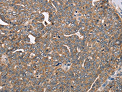 The image on the left is immunohistochemistry of paraffin-embedded Human cervical cancer tissue using CSB-PA286186(FAIM2 Antibody) at dilution 1/40, on the right is treated with fusion protein. (Original magnification: x200)