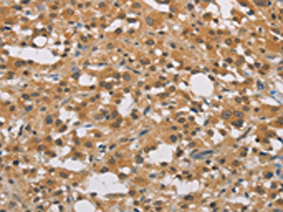 The image on the left is immunohistochemistry of paraffin-embedded Human thyroid cancer tissue using CSB-PA295249(DDX43 Antibody) at dilution 1/40, on the right is treated with fusion protein. (Original magnification: x200) The image on the left is immunohistochemistry of paraffin-embedded Human thyroid cancer tissue using CSB-PA295249(DDX43 Antibody) at dilution 1/40, on the right is treated with fusion protein. (Original magnification: x200)