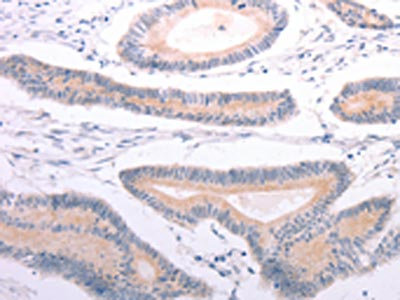 The image on the left is immunohistochemistry of paraffin-embedded Human colon cancer tissue using CSB-PA337817(ANGPTL2 Antibody) at dilution 1/20, on the right is treated with synthetic peptide. (Original magnification: x200)