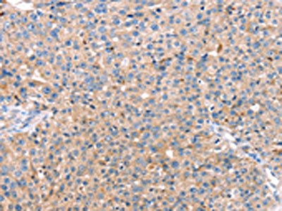 The image on the left is immunohistochemistry of paraffin-embedded Human breast cancer tissue using CSB-PA346002(CAPN7 Antibody) at dilution 1/20, on the right is treated with fusion protein. (Original magnification: x200)